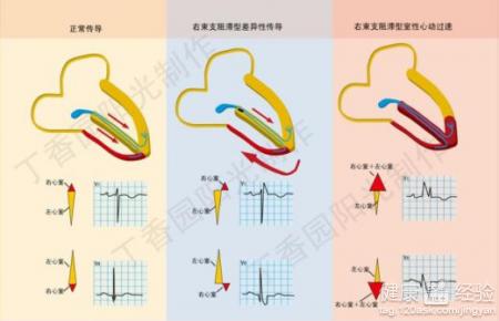 左束支傳導阻滯的預後預防