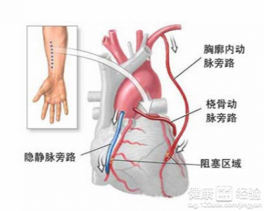 需要進行搭橋手術的臨床症狀