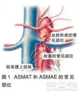 急性腸系膜血管缺血性疾病該如何治療