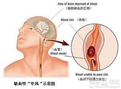 心腦血管疾病患者癱瘓要怎麼護理呢