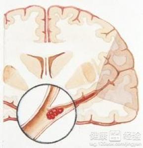 為什麼會得心腦血管疾病