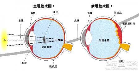 飛蚊症和腦血管疾病有關嗎