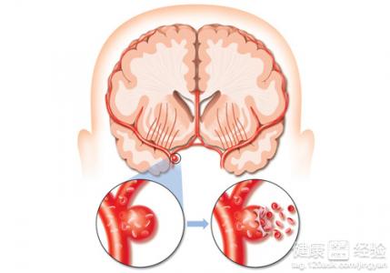 腦血管疾病有哪些症狀需要用些什麼藥物治