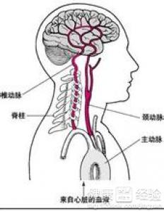 腦動脈硬化怎樣治療