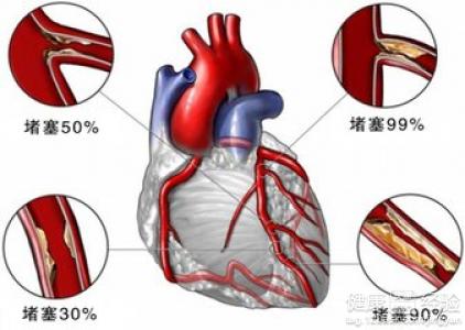 心腦血管疾病有偏方可以來治療嗎