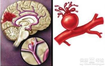 預防腦血管疾病秋季應該打那些針