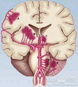 急性腦血管疾病應該做那些血液檢查