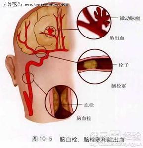 腦血管疾病吃什麼藥最好