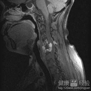 腦血管疾病有哪些分類