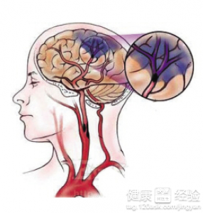 腦血管疾病吃什麼食物對身體有幫助