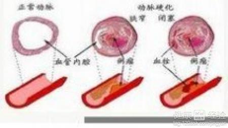 低血糖患者急性發作，要如何緩和呢？