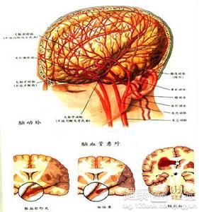 腦血管畸形要怎麼進行治療？