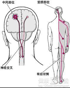 中風的危險因素有哪些