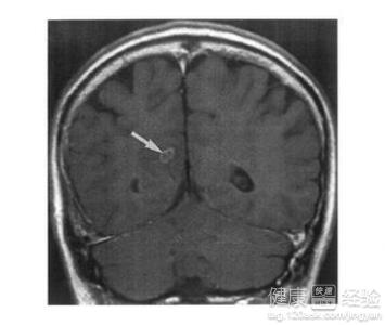 腦型血吸蟲病怎麼治療？