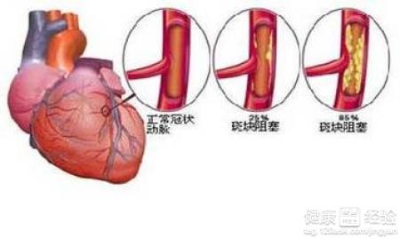 冠心病的四種確診方法