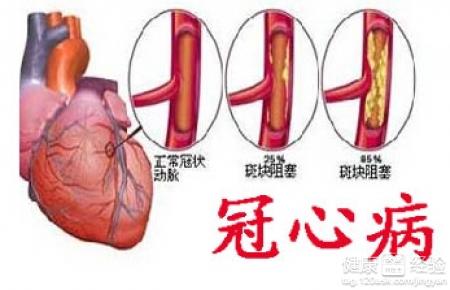 早期冠心病症狀表現是什麼