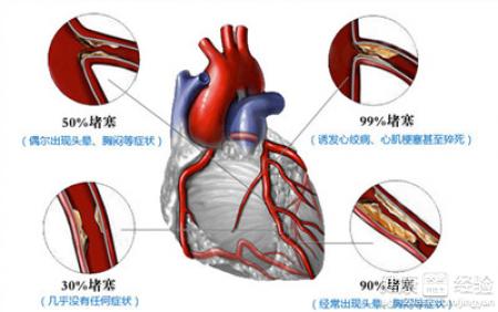 引起冠心病常見的原因