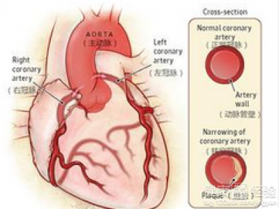 冠心病的自我保健!忌8件事!