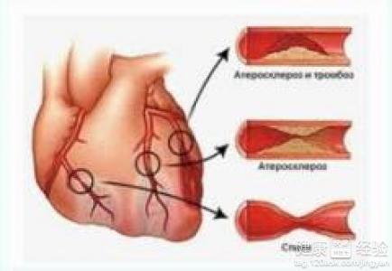 輕微冠心病能治好嗎
