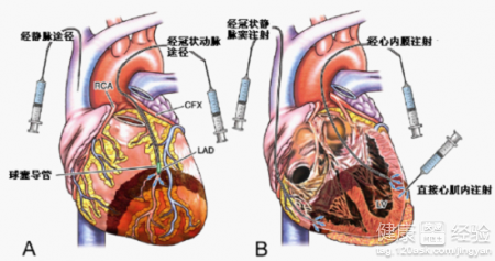 冠心病最新治療方法