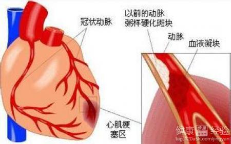 中醫冠心病的3個治療方法