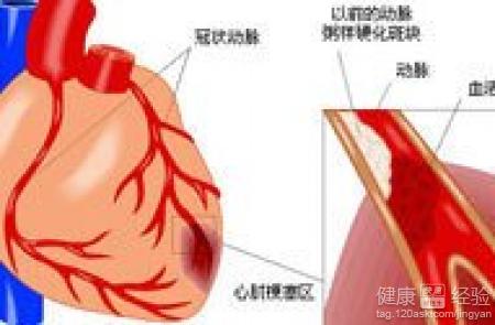 心絞痛與冠心病的區別