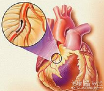 什麼藥治療冠心病最好