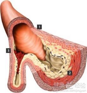 冠心病二期要怎麼預防