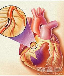 冠心病怎麼治療呢