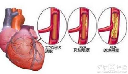 治療冠心病用什麼藥