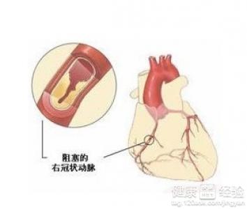 冠心病不可以吊瓶嗎