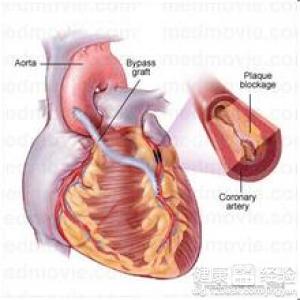 冠心病的早期診斷