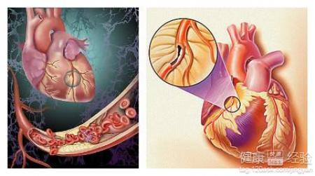 冠心病的體征是怎樣