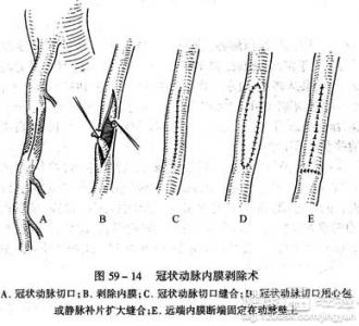 冠心病臨床診斷與治療方案