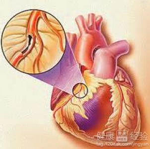 冠心病早期症狀什麽樣
