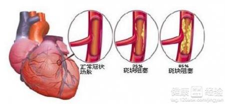 冠心病有哪些體征