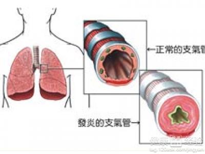 冠心病發作症狀