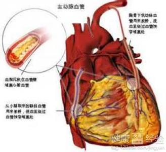 冠心病症狀及治療