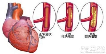 冠心病的最佳治療