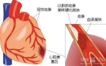 冠心病是怎麼引起的