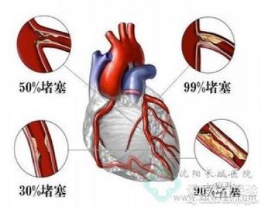 冠心病的病因