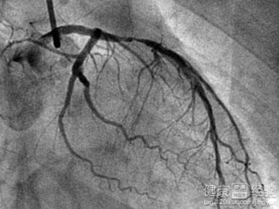 冠心病造影多少錢