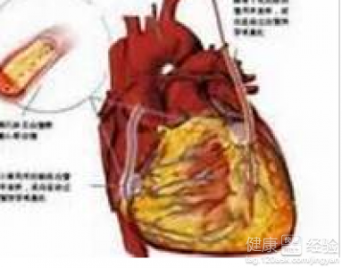 導致冠心病的原因有哪些