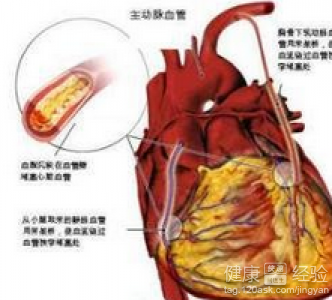 冠心病飲食禁忌有哪些