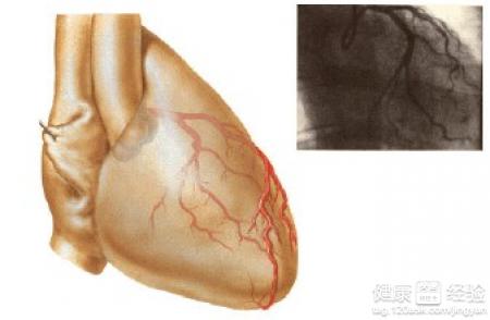 患了冠心病必須做冠脈造影嗎