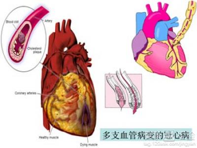 患冠心病怎麼調整心態