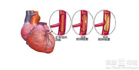 冠心病的症狀是怎麼樣的