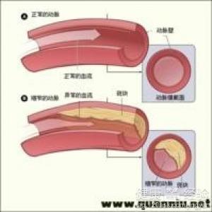 冠心病引起的腸系膜血管栓塞怎麼辦