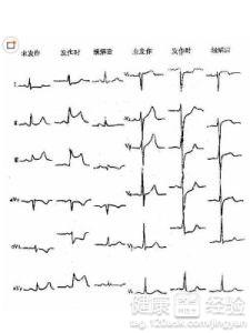 冠心病心絞痛最新診斷標准是什麼