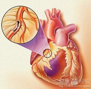 什麼辦法能根治冠心病